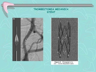 TROMBECTOMIA MECANICA
        STENT
 