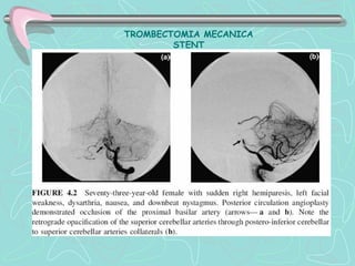 TROMBECTOMIA MECANICA
        STENT
 