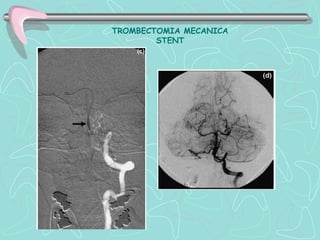 TROMBECTOMIA MECANICA
        STENT
 