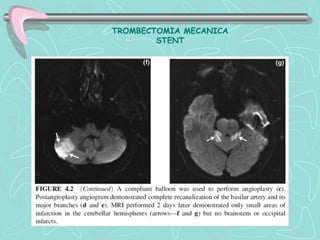 TROMBECTOMIA MECANICA
        STENT
 