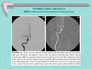 TROMBECTOMIA MECANICA
MERCI (Mechanical Embolus Removal in Cerebral Ischemia)
 