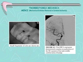TROMBECTOMIA MECANICA
MERCI (Mechanical Embolus Removal in Cerebral Ischemia)
 