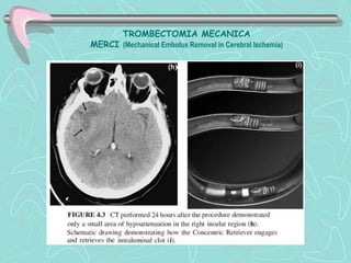 TROMBECTOMIA MECANICA
MERCI (Mechanical Embolus Removal in Cerebral Ischemia)
 