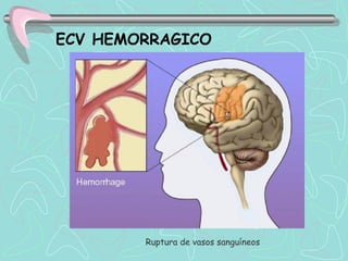 ECV HEMORRAGICO




        Ruptura de vasos sanguíneos
 
