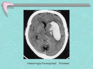 Hemorragia Parenquimal. Putamen
 