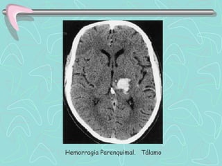 Hemorragia Parenquimal. Tálamo
 