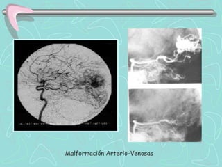 Malformación Arterio-Venosas
 