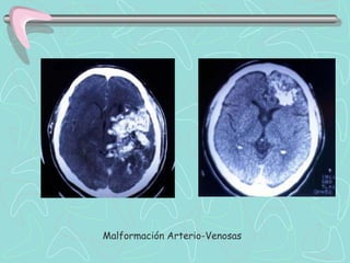 Malformación Arterio-Venosas
 