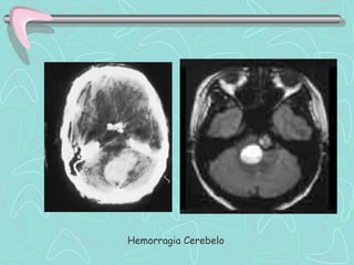 Hemorragia Cerebelo
 