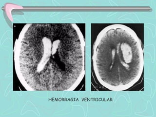 HEMORRAGIA VENTRICULAR
 