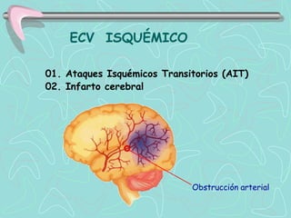 ECV ISQUÉMICO

01. Ataques Isquémicos Transitorios (AIT)
02. Infarto cerebral




                             Obstrucción arterial
 