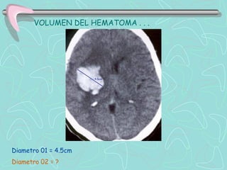 VOLUMEN DEL HEMATOMA . . .




Diametro 01 = 4.5cm
Diametro 02 = ?
 