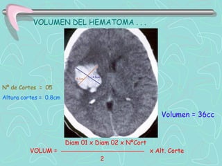 VOLUMEN DEL HEMATOMA . . .




Nº de Cortes = 05
Altura cortes = 0.8cm


                                                         Volumen = 36cc


                        Diam 01 x Diam 02 x NºCort
          VOLUM =                                    x Alt. Corte
                                   2
 