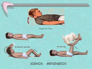 Rigidez de Nuca




SIGNOS      MENINGEOS
 