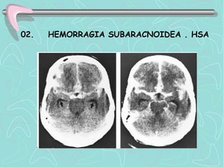 02.   HEMORRAGIA SUBARACNOIDEA . HSA
 