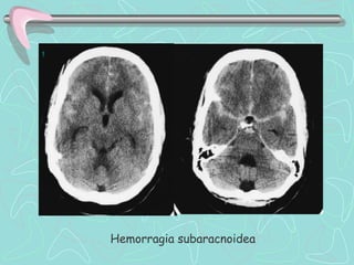 ,




    Hemorragia subaracnoidea
 