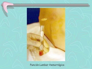 Punción Lumbar Hemorrágica
 