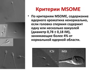 Критерии MSOME
• По критериям MSOME, содержание
ядерного хроматина ненормально,
если головка спермия содержит
одну или несколько вакуолей
(диаметр 0,78 ± 0,18 IM),
занимающие более 4% от
нормальной ядерной области.
 