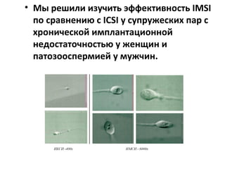 • Мы решили изучить эффективность IMSI
по сравнению с IСSI у супружеских пар с
хронической имплантационной
недостаточностью у женщин и
патозооспермией у мужчин.
 