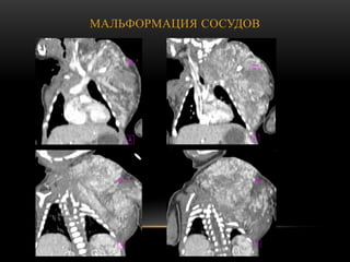 МАЛЬФОРМАЦИЯ СОСУДОВ
 