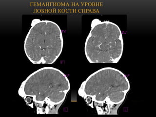 ГЕМАНГИОМА НА УРОВНЕ
ЛОБНОЙ КОСТИ СПРАВА
 