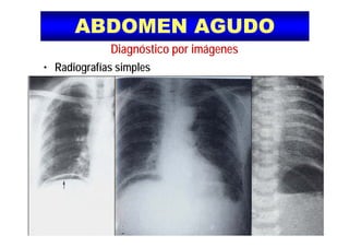 ABDOMEN AGUDOABDOMEN AGUDO
Diagnóstico por imágenes
• Radiografías simples• Radiografías simples
 