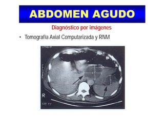 ABDOMEN AGUDOABDOMEN AGUDO
Diagnóstico por imágenes
• Tomografía Axial Computarizada y RNM
 