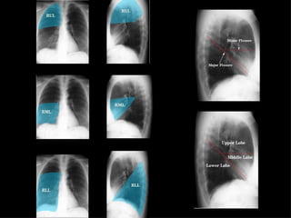 Chest Radiographic Anatomy for radiology rotation | PPTX