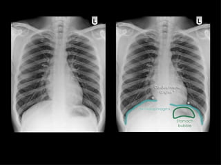 Chest Radiographic Anatomy for radiology rotation | PPTX