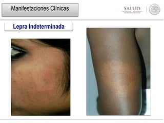 Lepra Indeterminada
Manifestaciones Clínicas
 