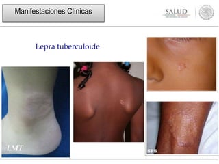 LMT
Lepra tuberculoide
Manifestaciones Clínicas
 