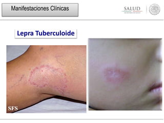 Lepra Tuberculoide
Manifestaciones Clínicas
 