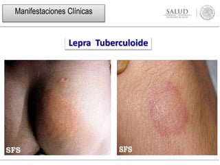 Lepra Tuberculoide
Manifestaciones Clínicas
 