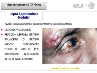 NODULO CERCA DE LA CORNEA
LESIONES VISCERALES:
REACCION LEPROSA: ERITEMA
POLIMORFO O ERITEMA
NUDOSO: NUDOSIDADES
FIEBRE DE MAS DE 40ºC,
ARTRALGIAS NEURALGIAS,
IRITIS, ORQUIEPIDIDIMITIS
OJOS: Nódulos cornéanos, queratitis infiltrativa, queratitis punteada
Manifestaciones Clínicas
Lepra Lepromatosa
Nódular
 