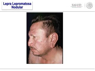Lepra Lepromatosa
Nodular
 