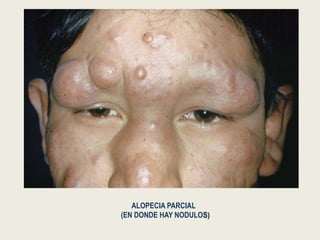ALOPECIA PARCIAL
(EN DONDE HAY NODULOS)
 