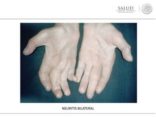 NEURITIS BILATERAL
 