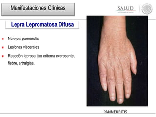 PANNEURITIS
Nervios: pannerutis
Lesiones viscerales
Reacción leprosa tipo eritema necrosante,
fiebre, artralgias.
Lepra Lepromatosa Difusa
Manifestaciones Clínicas
 