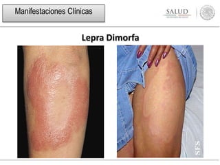 Lepra Dimorfa
Manifestaciones Clínicas
 