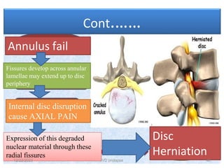 002_Intervertebral-disc-prolapse ppt.pdf