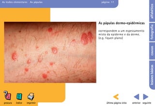 As lesões elementares   As pápulas    página: 17




                                                                                alfabético
                                     As pápulas dermo-epidérmicas




                                                                                fotografia
                                     correspondem a um espessamento
                                     misto da epiderme e da derme.
                                     (e.g. líquen plano)




                                                                                causas
                                                                                lesiones básicas
 procura   índice   imprimir              última página vista   anterior seguinte
 