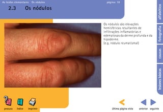 As lesões elementares   Os nódulos     página: 18




                                                                                 alfabético
    2.3             Os nódulos

                                     Os nódulos são elevações




                                                                                 fotografia
                                     hemisféricas resultantes de
                                     infiltrações inflamatórias e
                                     edematosas da derme profunda e da
                                     hipoderme.
                                     (e.g. nódulo reumatismal)




                                                                                 causas
                                                                                 lesiones básicas
 procura   índice    imprimir              última página vista   anterior seguinte
 