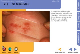 As lesões elementares   Os tubérculos     página: 19




                                                                                    alfabético
    2.4             Os tubérculos

                                        Os tubérculos são formações




                                                                                    fotografia
                                        sólidas, salientes, circunscritas,
                                        encaixadas superficialmente na
                                        derme. Ulceram-se, por vezes,
                                        durante a sua evolução.
                                        (e.g. lúpus tuberculoso)




                                                                                    causas
                                                                                    lesiones básicas
 procura   índice    imprimir                 última página vista   anterior seguinte
 