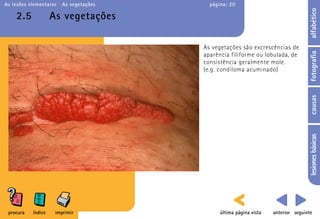 As lesões elementares   As vegetações     página: 20




                                                                                    alfabético
    2.5             As vegetações

                                        As vegetações são excrescências de




                                                                                    fotografia
                                        aparência filiforme ou lobulada, de
                                        consistência geralmente mole.
                                        (e.g. condiloma acuminado)




                                                                                    causas
                                                                                    lesiones básicas
 procura   índice    imprimir                 última página vista   anterior seguinte
 