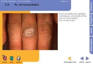 As lesões elementares   As verrucosidades     página: 21




                                                                                        alfabético
    2.6             As verrucosidades

                                            As verrucosidades são vegetações




                                                                                        fotografia
                                            revestidas por uma camada córnea
                                            mais ou menos espessa.
                                            (e.g. verruga vulgar)




                                                                                        causas
                                                                                        lesiones básicas
 procura   índice    imprimir                     última página vista   anterior seguinte
 