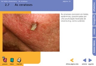 As lesões elementares   As ceratoses     página: 22




                                                                                   alfabético
    2.7             As ceratoses

                                       As ceratoses consistem em lesões




                                                                                   fotografia
                                       epidérmicas, caracterizadas por
                                       uma acumulação localizada de
                                       ceratina (e.g. corno cutâneo).




                                                                                   causas
                                                                                   lesiones básicas
 procura   índice    imprimir                última página vista   anterior seguinte
 