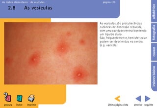 As lesões elementares   As vesículas     página: 23




                                                                                   alfabético
    2.8             As vesículas

                                       As vesículas são protuberâncias




                                                                                   fotografia
                                       cutâneas de dimensão reduzida,
                                       com uma cavidade central contendo
                                       um líquido claro.
                                       São, frequentemente, hemisféricas e
                                       podem ser deprimidas no centro.
                                       (e.g. varicela)




                                                                                   causas
                                                                                   lesiones básicas
 procura   índice    imprimir                última página vista   anterior seguinte
 