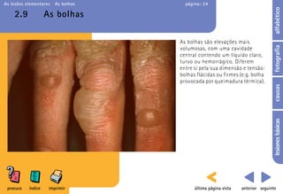 As lesões elementares   As bolhas     página: 24




                                                                                alfabético
    2.9             As bolhas

                                    As bolhas são elevações mais




                                                                                fotografia
                                    volumosas, com uma cavidade
                                    central contendo um líquido claro,
                                    turvo ou hemorrágico. Diferem
                                    entre si pela sua dimensão e tensão:
                                    bolhas flácidas ou firmes (e.g. bolha
                                    provocada por queimadura térmica).




                                                                                causas
                                                                                lesiones básicas
 procura   índice    imprimir             última página vista   anterior seguinte
 