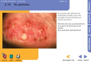 As lesões elementares   As pústulas     página: 25




                                                                                  alfabético
    2.10            As pústulas

                                      As pústulas são saliências de




                                                                                  fotografia
                                      dimensões variadas, com uma
                                      cavidade central contendo um
                                      líquido purulento.

                                      Ocorrem de novo ou desenvolvem-
                                      se a partir de vesículas ou de




                                                                                  causas
                                      bolhas.
                                      (e.g. pustulose palmoplantar)




                                                                                  lesiones básicas
 procura   índice    imprimir               última página vista   anterior seguinte
 