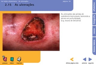 As lesões elementares   As ulcerações     página: 30




                                                                                    alfabético
    2.15            As ulcerações

                                        As ulcerações são perdas de




                                                                                    fotografia
                                        substância mais graves, lacerando a
                                        derme em profundidade.
                                        (e.g. escara de decúbito)




                                                                                    causas
                                                                                    lesiones básicas
 procura   índice    imprimir                 última página vista   anterior seguinte
 